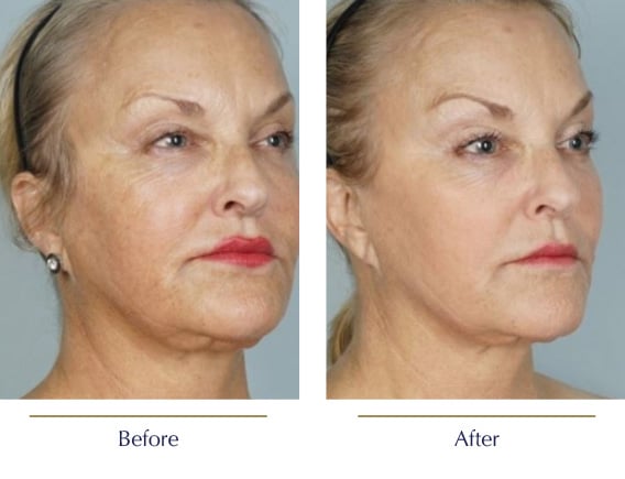 Before-and-after-CoolPeel2
