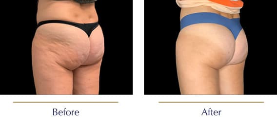 Before-and-after-Emtone-Cellulite5
