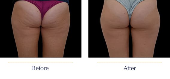 Before-and-after-Emtone-Cellulite6