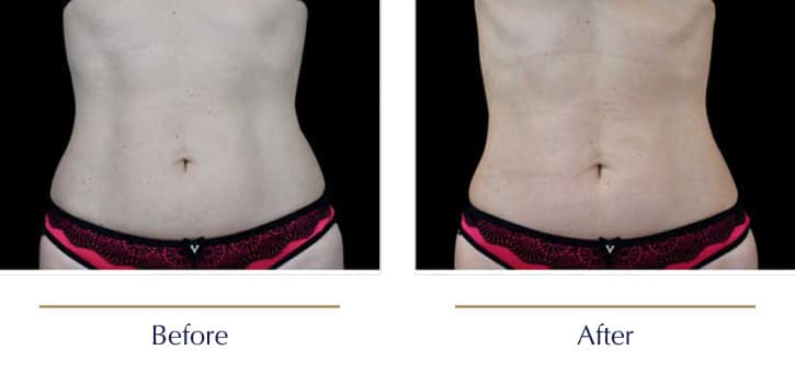 EMsculpt-Before-and-after