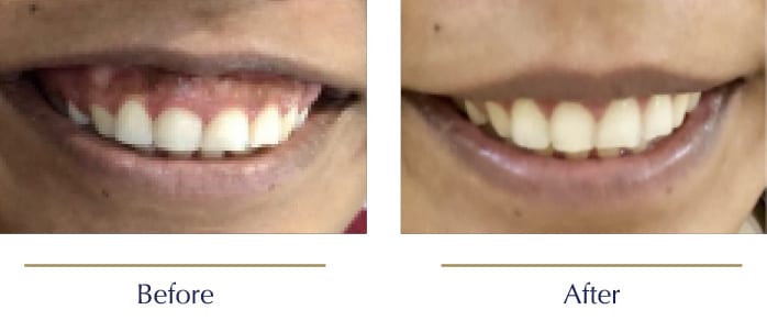 Gummy-Smile-Before-and-after-the-ghanem-clinic