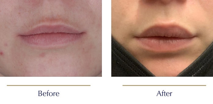 Scarless-Lip-Lift-Before-and-after