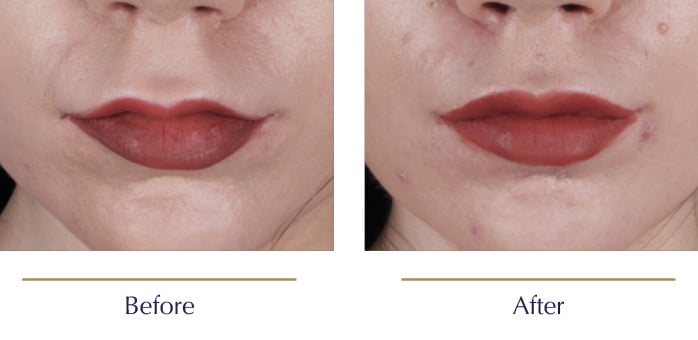 Scarless-Lip-Lift-Before-and-after2