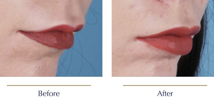 Scarless-Lip-Lift-Before-and-after4