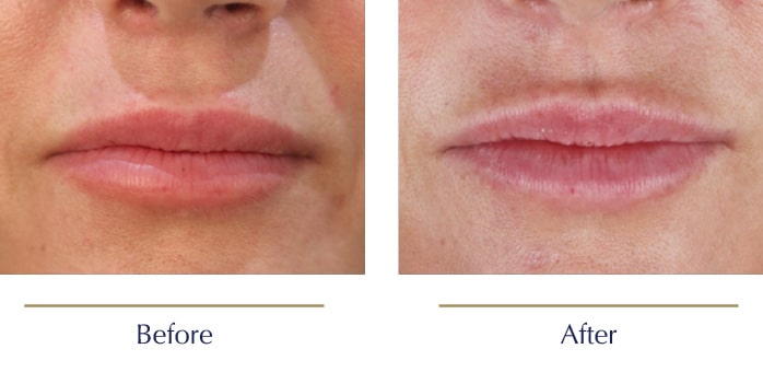 Scarless-Lip-Lift-Before-and-after5