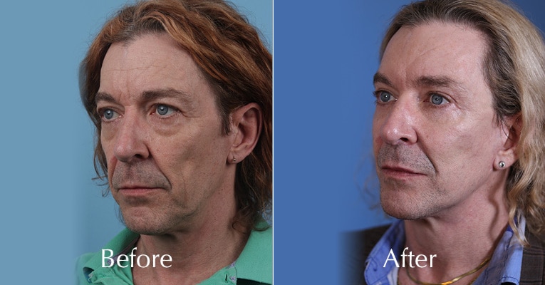 john-kelleher-before-and-after-hero