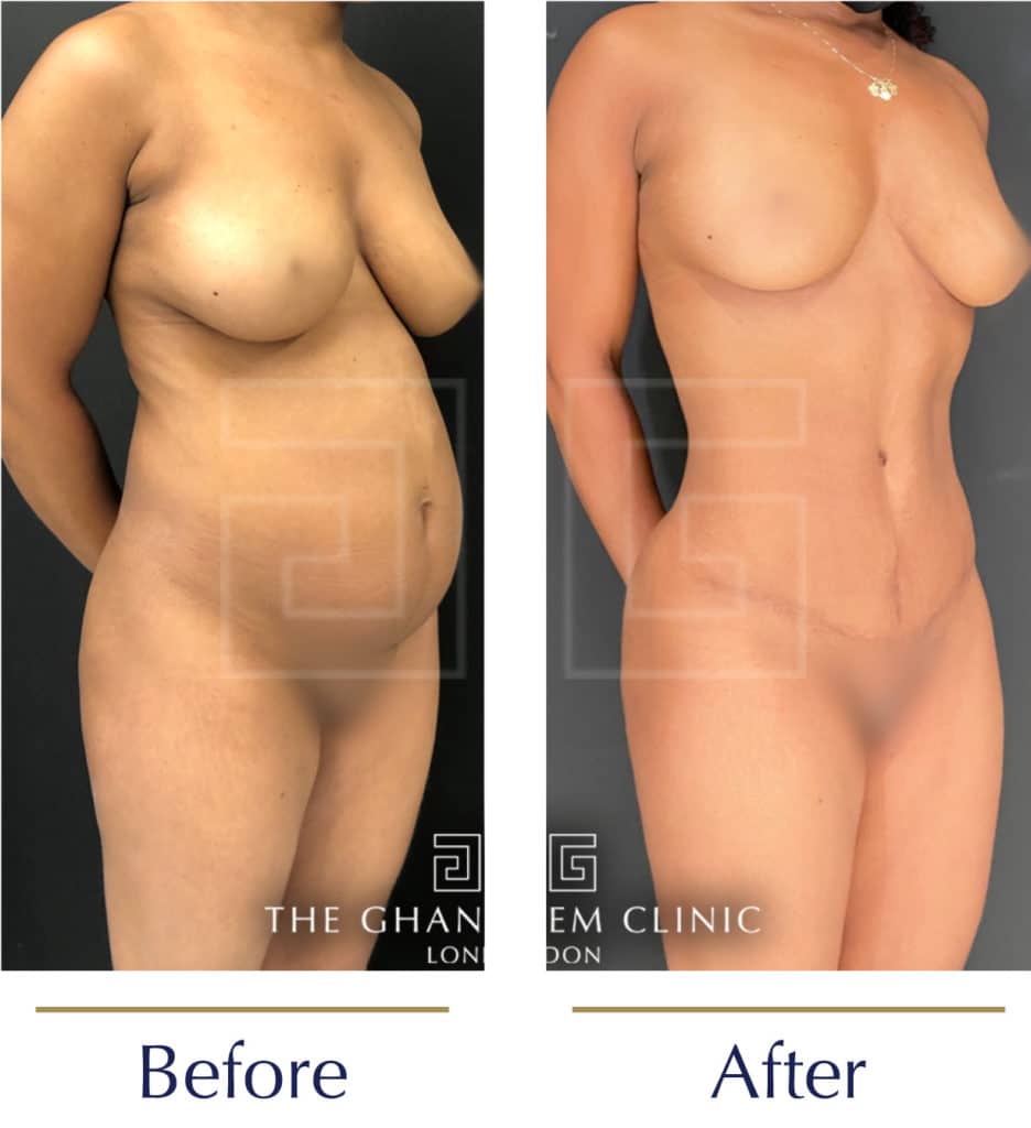 Lipoabdominoplasty-before-and-after5