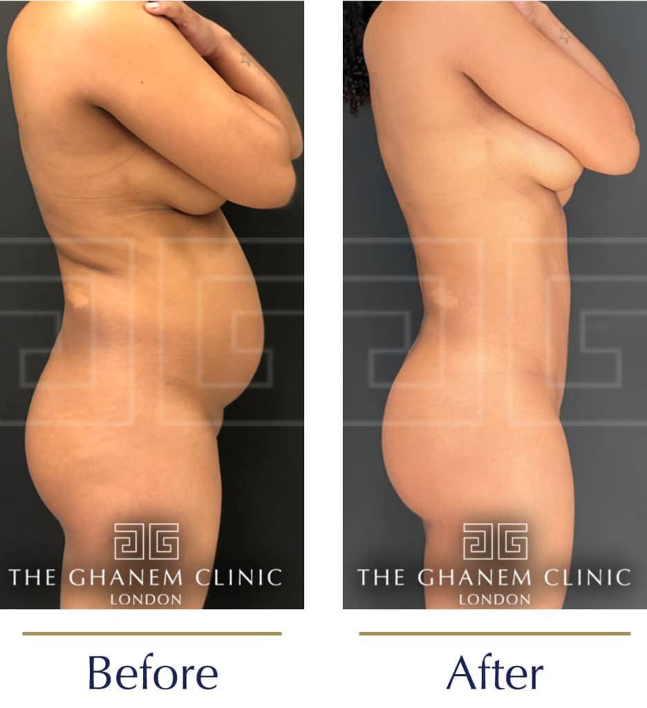 Lipoabdominoplasty-before-and-after6