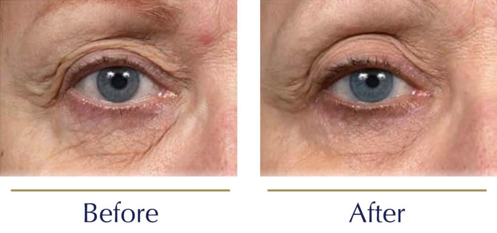 Thermage-Before-and-after